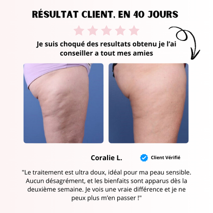 Masseur Anti-Cellulite